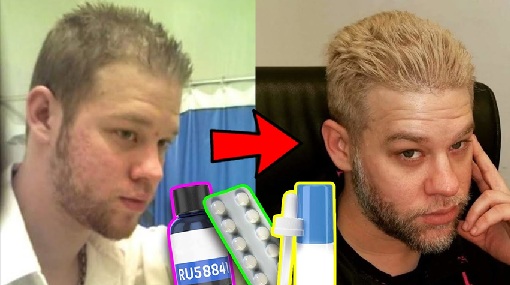 RU58841 before and after
